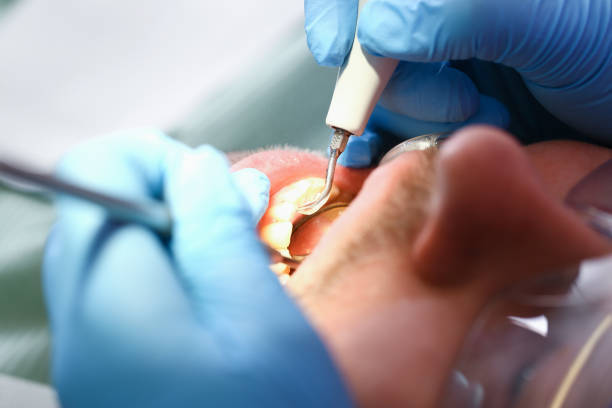 Best Emergency Root Canal Treatment in Penryn, CA