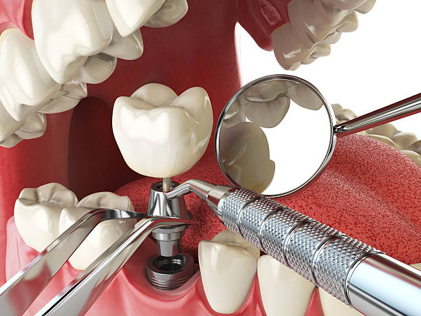 Best Emergency Dentist for Knocked-Out Tooth in Penryn, CA